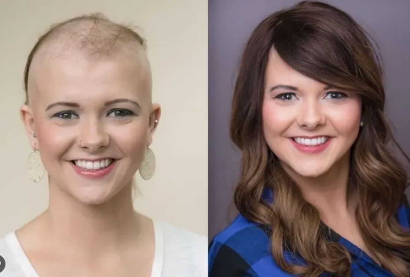 Woman before and after hair transformation; bald left, full brown hair right.