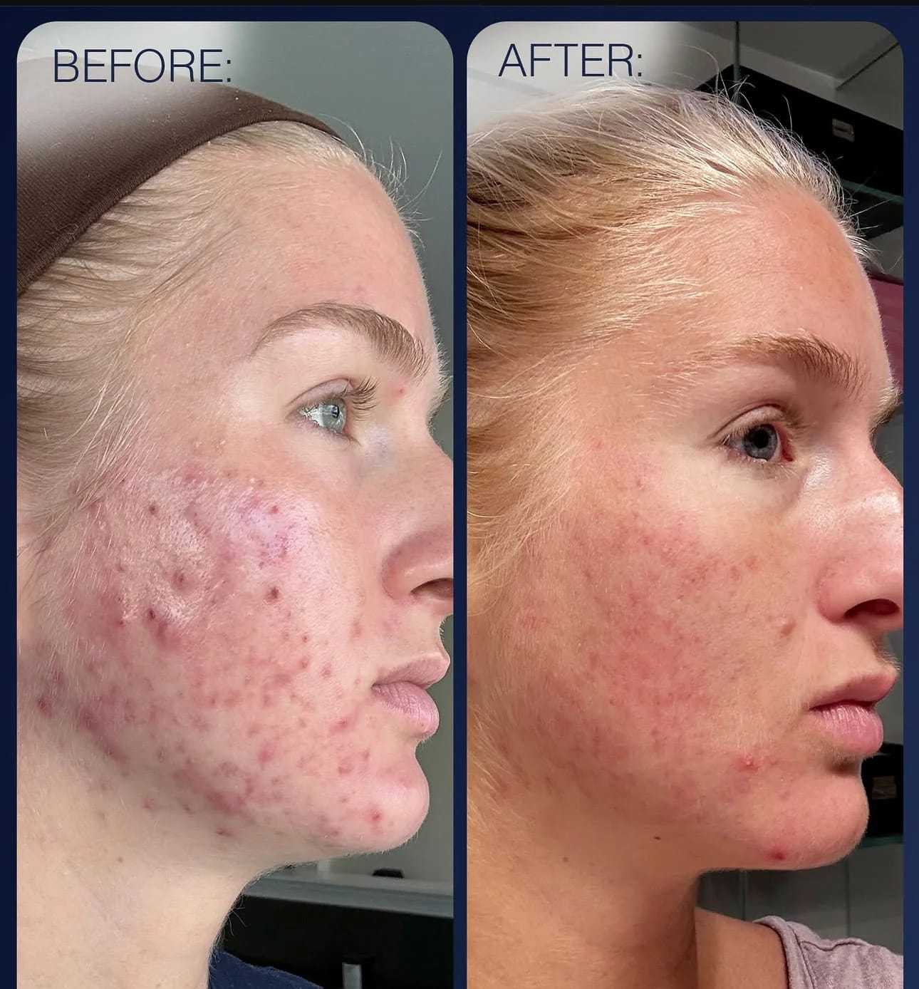 Side-by-side of a woman's face showing acne improvement in the after image.