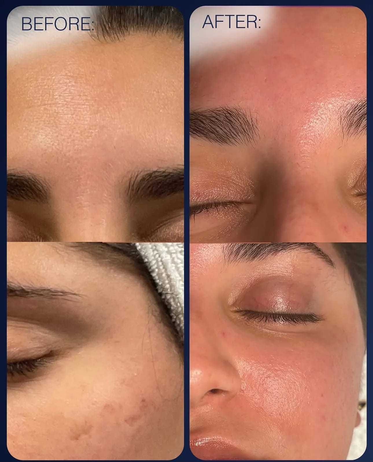 Before and after close-ups showing improved skin texture and reduced blemishes.